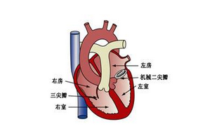 心力衰竭的治疗方式都有