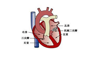 儿童患风湿性心脏病的主要病因是什么？