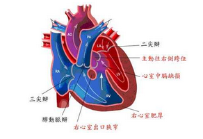 风湿性心脏病发病原因及其预防措施