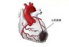 心肌缺血的原因与危害