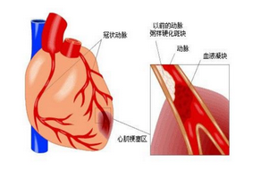 心肌缺血的症状有哪些？又该如何治疗？