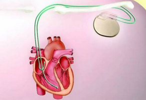 安装心脏起搏器的各种注意事项有哪些？