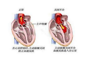 二尖瓣关闭不全的日常护理
