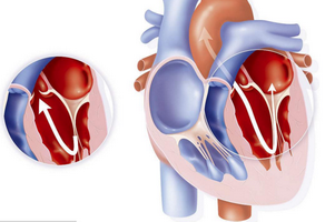 二尖瓣关闭不全的症状有哪些？