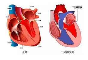 二尖瓣关闭不全要做的检查有哪些？