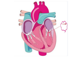 二尖瓣狭窄的危害性