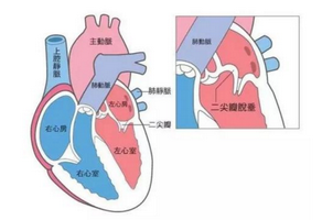 二尖瓣狭窄症状有哪些