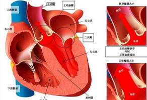 风湿性心脏病是什么？