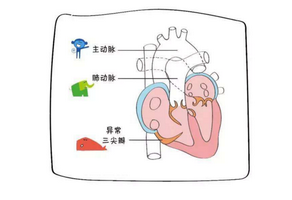 三尖瓣狭窄该如何预防