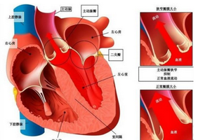 心脏瓣膜病手术为什么要换瓣膜？