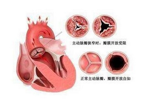 主动脉瓣关闭不全的原因有哪些