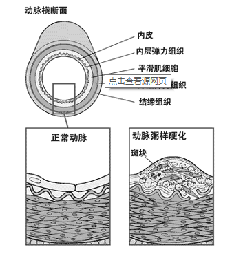 哪些人受动脉硬化“青睐”