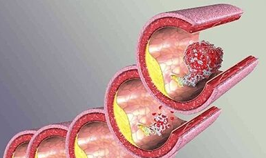 糖尿病人易引发动脉硬化