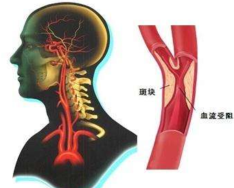 头痛会引发动脉硬化吗