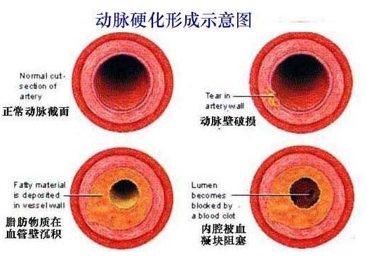 下肢动脉硬化闭塞症发现要及时