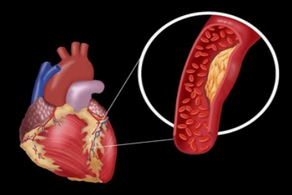 冠心病的15个典型症状介绍