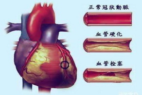 冠心病合并高血压睡前不宜喝太多水